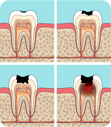 OraRisk Caries